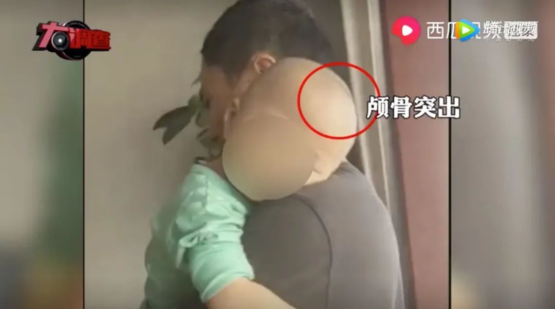 Một bé sử dụng sữa BeiAnMin bị đầu to nhưng mình nhỏ